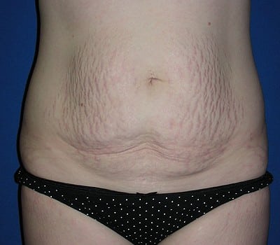 Before Image: Abdominoplasty Simultaneous Gynecological Procedure - front