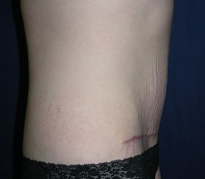 After Image: Abdominoplasty Simultaneous Gynecological Procedure - other