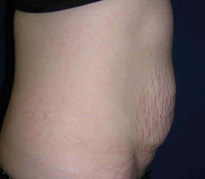 Before Image: Abdominoplasty Simultaneous Gynecological Procedure - other
