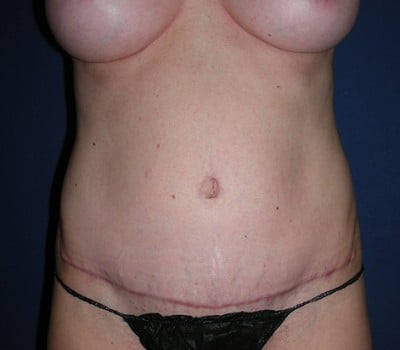 After Image: Abdominoplasty Simultaneous Breast Aug - front