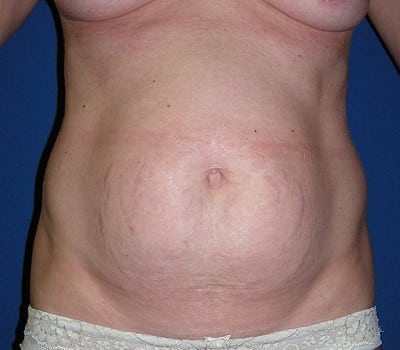 Before Image: Abdominoplasty Simultaneous Breast Aug - front