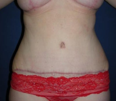 After Image: Abdominoplasty After Multiple Pregnancies - front