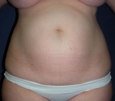 Before Image: Abdominoplasty After Multiple Pregnancies - front