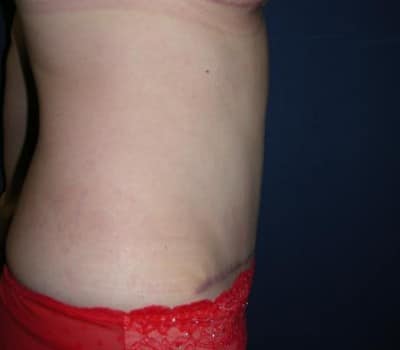 After Image: Abdominoplasty After Multiple Pregnancies - other