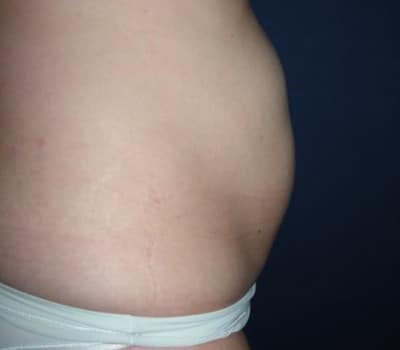 Before Image: Abdominoplasty After Multiple Pregnancies - other
